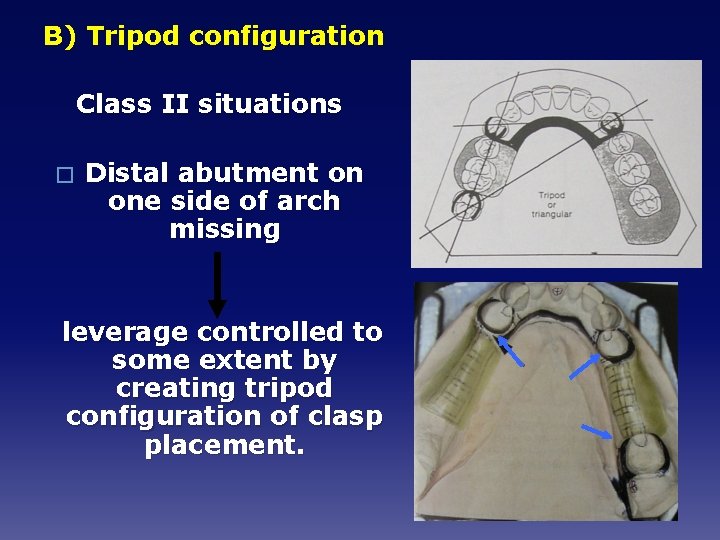 B) Tripod configuration Class II situations � Distal abutment on one side of arch