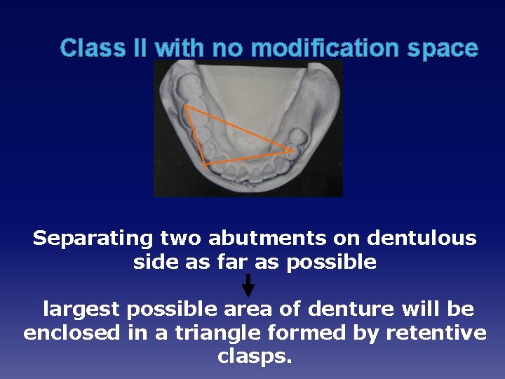 Class II with no modification space Separating two abutments on dentulous side as far