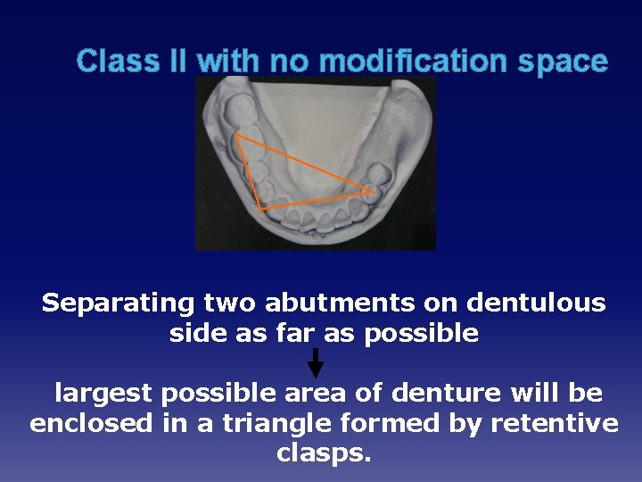 Class II with no modification space Separating two abutments on dentulous side as far