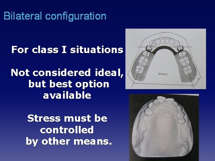 Bilateral configuration For class I situations Not considered ideal, but best option available Stress
