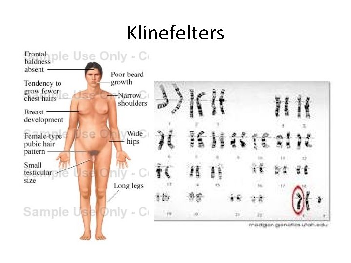 Klinefelters 