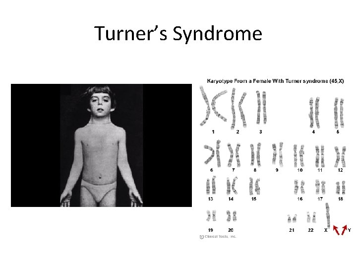 Turner’s Syndrome 