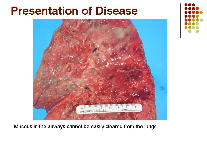 Presentation of Disease Mucous in the airways cannot be easily cleared from the lungs.