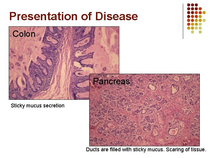 Presentation of Disease Colon Pancreas Sticky mucus secretion Ducts are filled with sticky mucus.