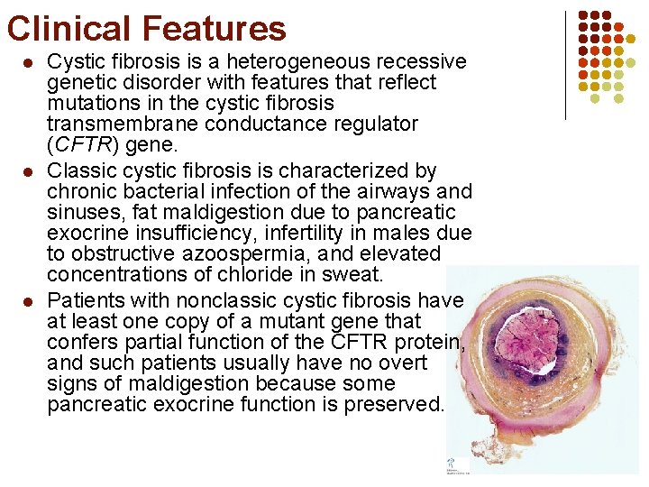 Clinical Features l l l Cystic fibrosis is a heterogeneous recessive genetic disorder with