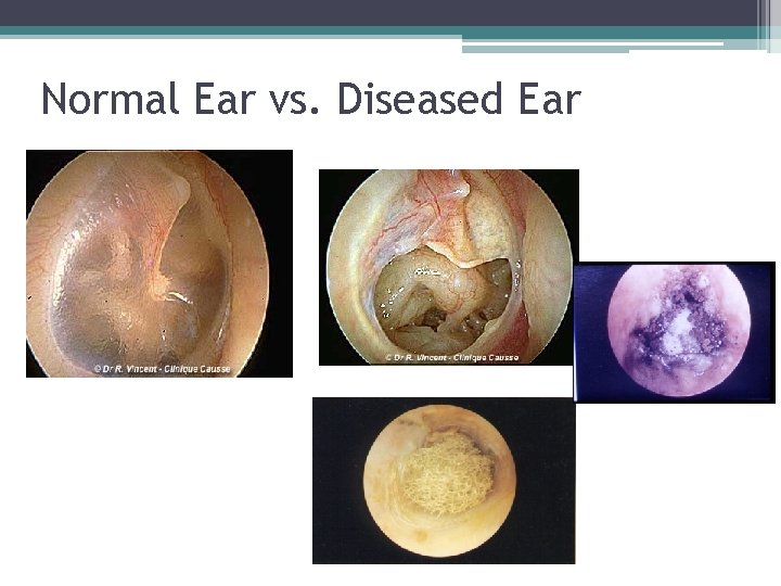 Normal Ear vs. Diseased Ear 