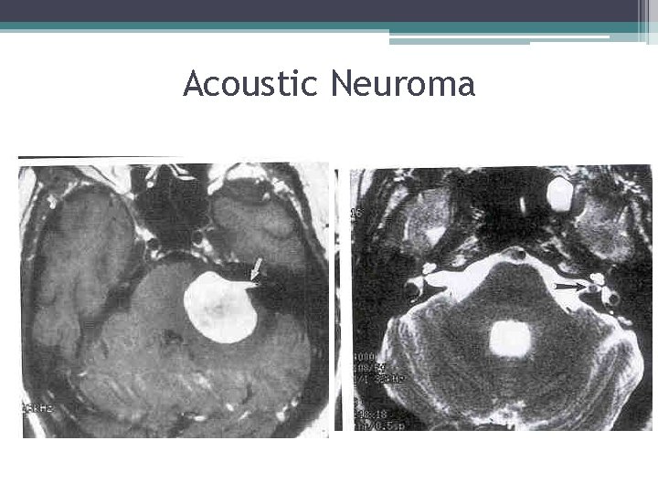 Acoustic Neuroma 