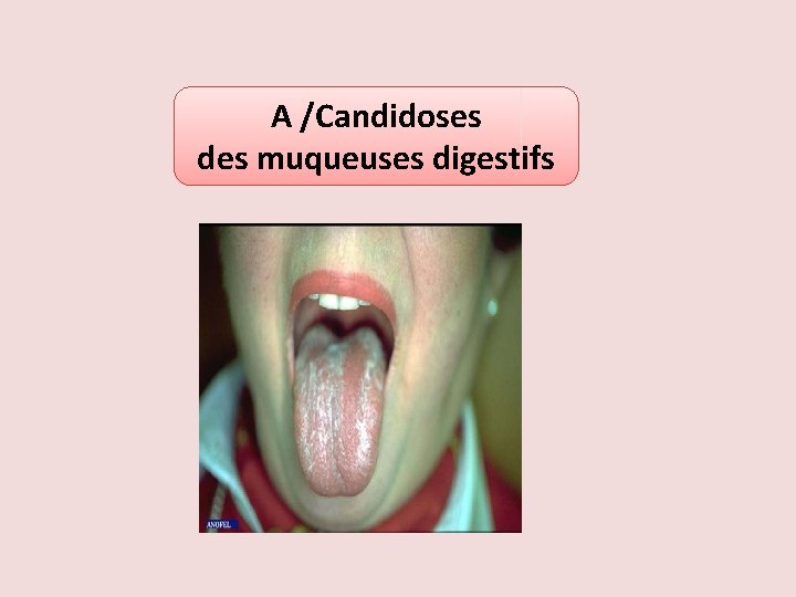 A /Candidoses des muqueuses digestifs 
