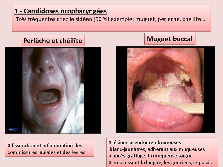 1 - Candidoses oropharyngées Très fréquentes chez le sidéen (50 %) exemple: muguet, perlèche,