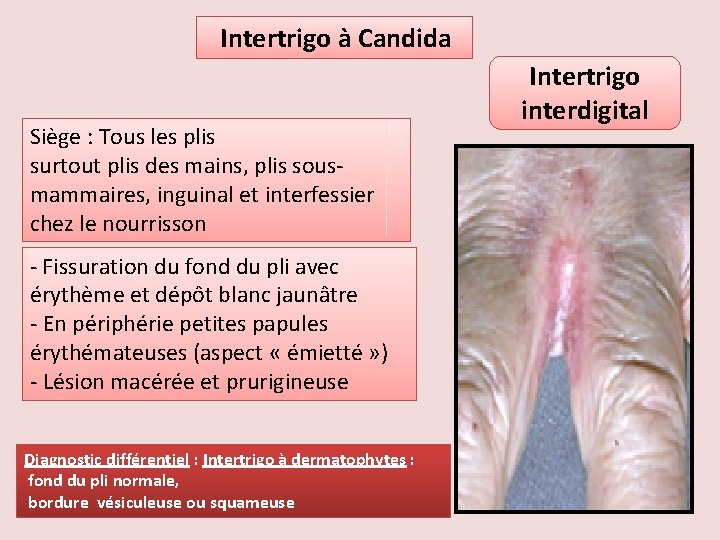 Intertrigo à Candida Siège : Tous les plis surtout plis des mains, plis