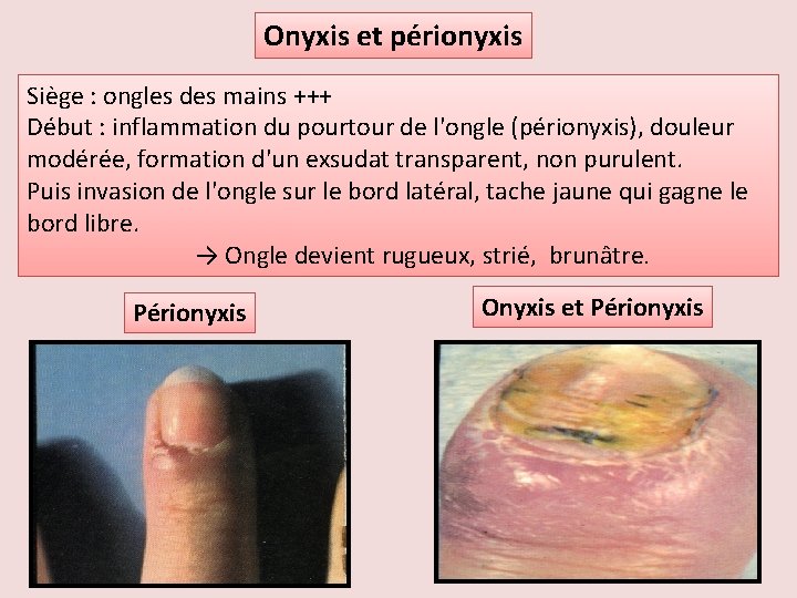 Onyxis et périonyxis Siège : ongles des mains +++ Début : inflammation du pourtour