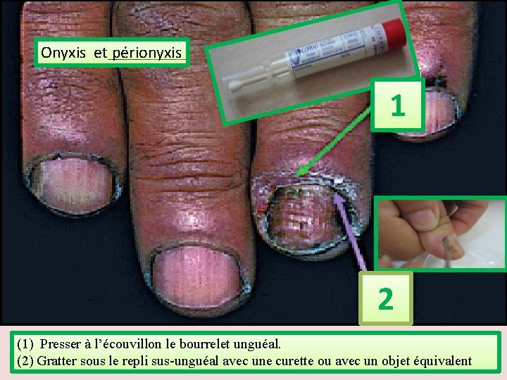 Onyxis et périonyxis 1 2 (1) Presser à l’écouvillon le bourrelet unguéal. (2) Gratter