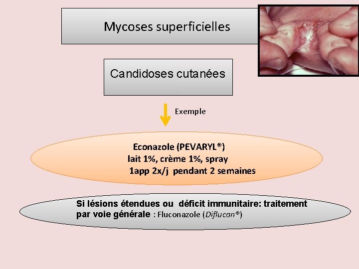 Mycoses superficielles Candidoses cutanées Exemple Econazole (PEVARYL®) lait 1%, crème 1%, spray 1 app