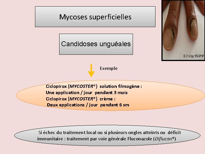 Mycoses superficielles Candidoses unguéales Exemple Ciclopirox (MYCOSTER®) solution filmogène : Une application / jour