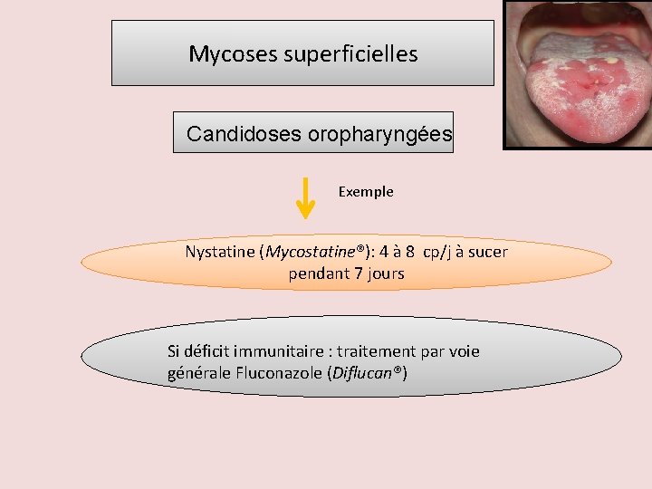 Mycoses superficielles Candidoses oropharyngées Exemple Nystatine (Mycostatine®): 4 à 8 cp/j à sucer pendant