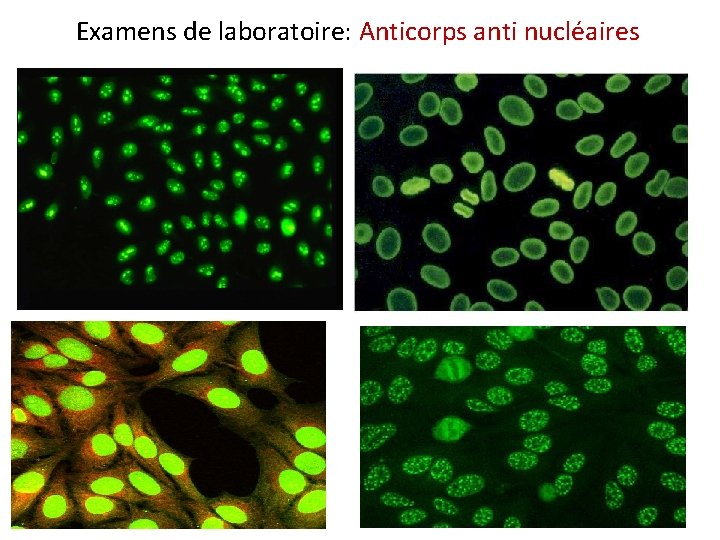 Examens de laboratoire: Anticorps anti nucléaires 