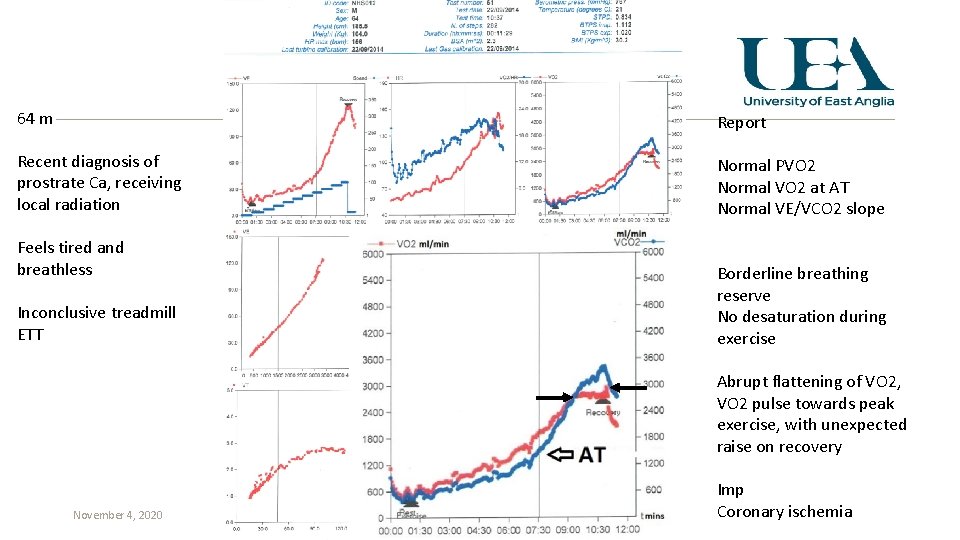 64 m Report Recent diagnosis of prostrate Ca, receiving local radiation Normal PVO 2