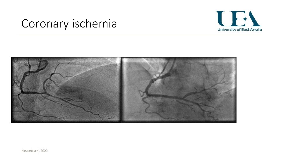Coronary ischemia November 4, 2020 