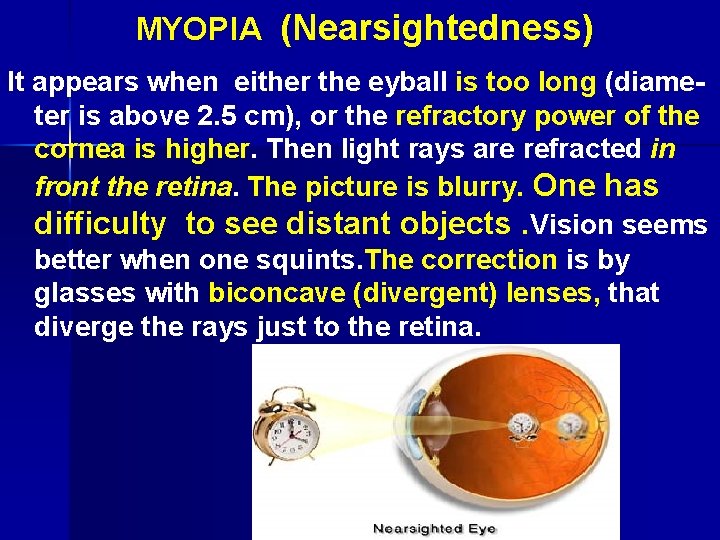  MYOPIA (Nearsightedness) It appears when either the eyball is too long (diameter is