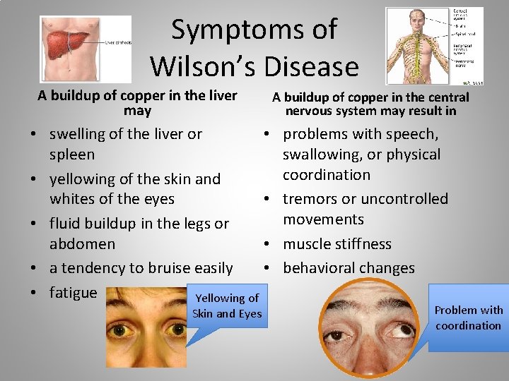 Symptoms of Wilson’s Disease A buildup of copper in the liver may • swelling