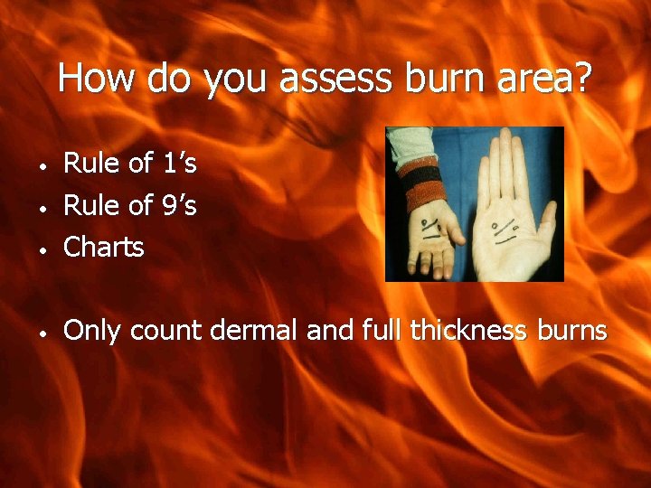 How do you assess burn area? • Rule of 1’s Rule of 9’s Charts