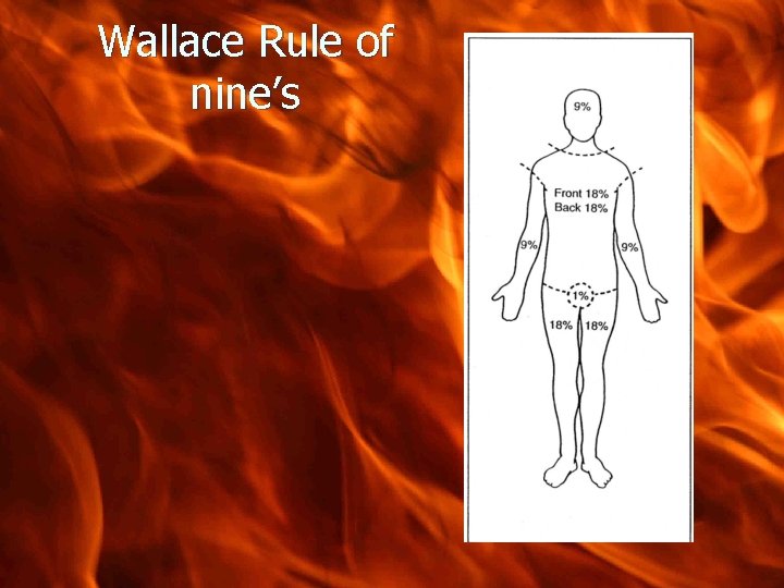 Wallace Rule of nine’s 