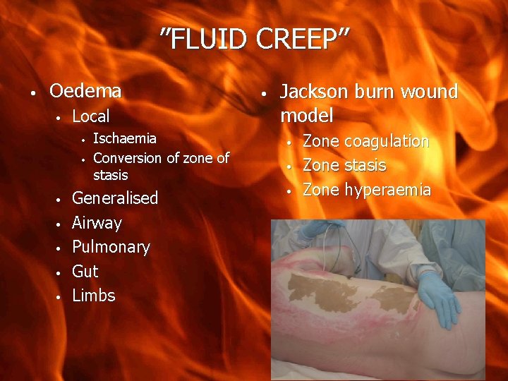 ”FLUID CREEP” • Oedema • Local • • Ischaemia Conversion of zone of stasis