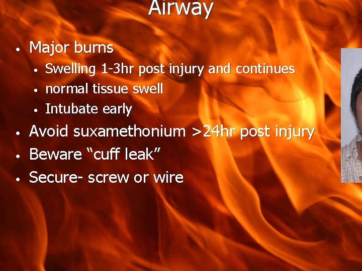 Airway • Major burns • • • Swelling 1 -3 hr post injury and