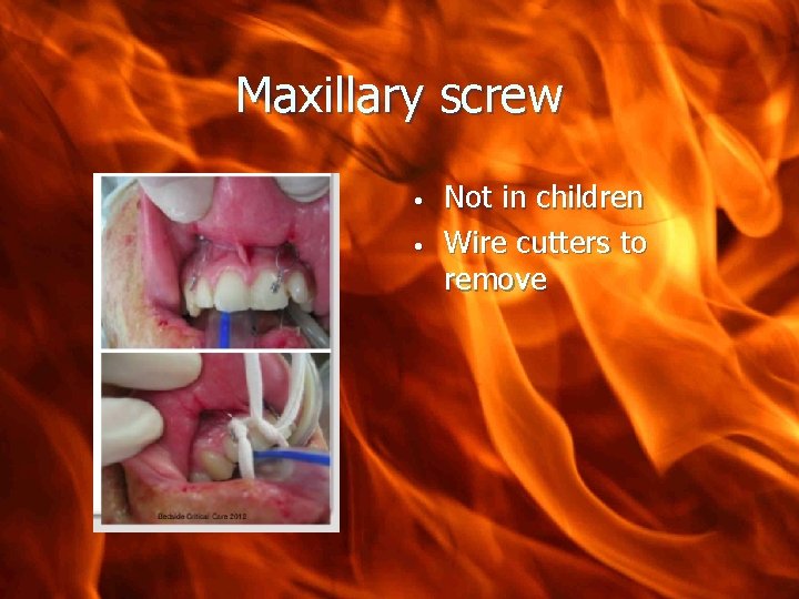 Maxillary screw • • Not in children Wire cutters to remove 
