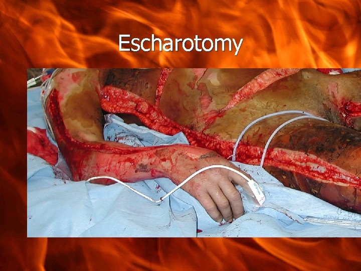 Escharotomy 