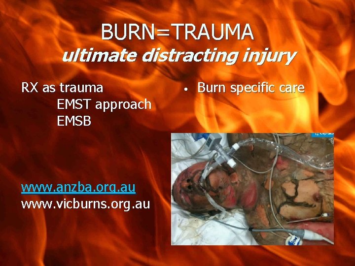 BURN=TRAUMA ultimate distracting injury RX as trauma EMST approach EMSB www. anzba. org. au