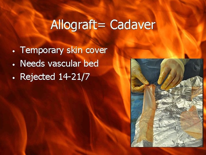 Allograft= Cadaver • • • Temporary skin cover Needs vascular bed Rejected 14 -21/7