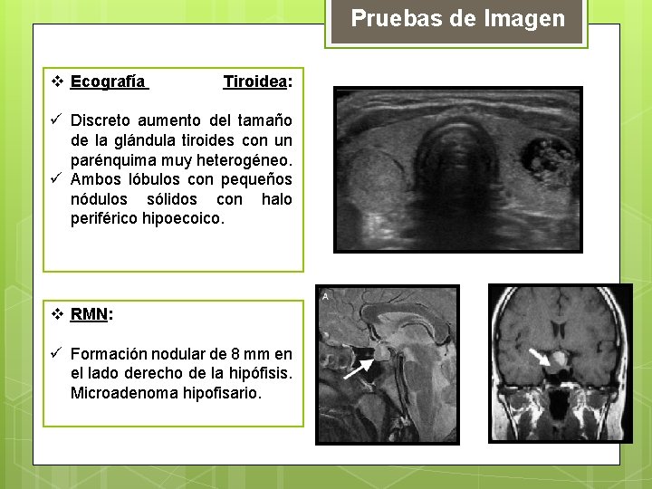 Pruebas de Imagen v Ecografía Tiroidea: ü Discreto aumento del tamaño de la glándula