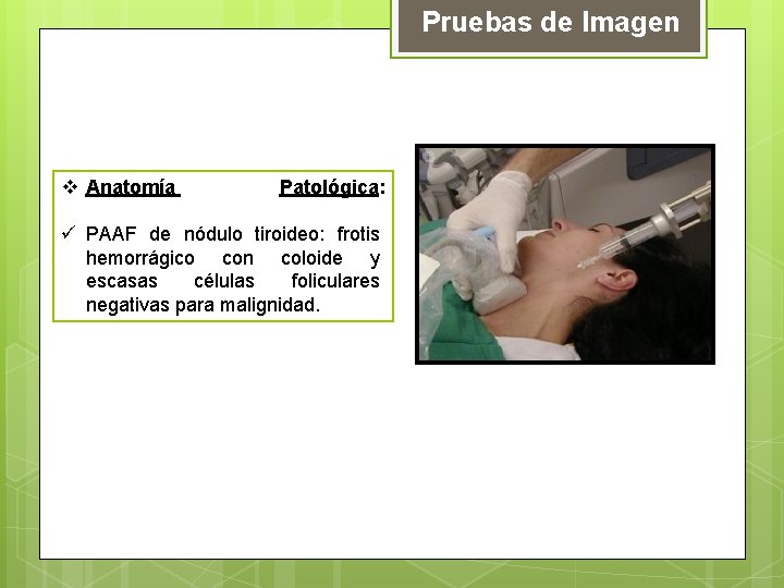 Pruebas de Imagen v Anatomía Patológica: ü PAAF de nódulo tiroideo: frotis hemorrágico con