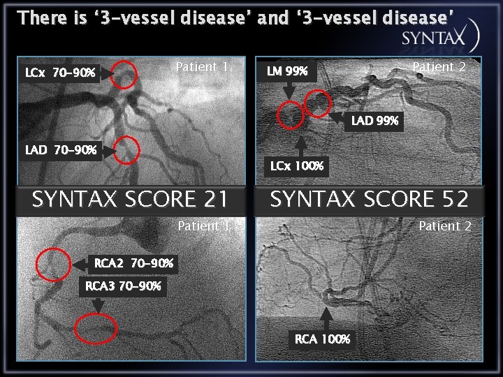 There is ‘ 3 -vessel disease’ and ‘ 3 -vessel disease’ LCx 70 -90%