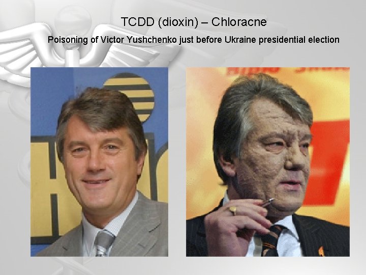 TCDD (dioxin) – Chloracne Poisoning of Victor Yushchenko just before Ukraine presidential election 
