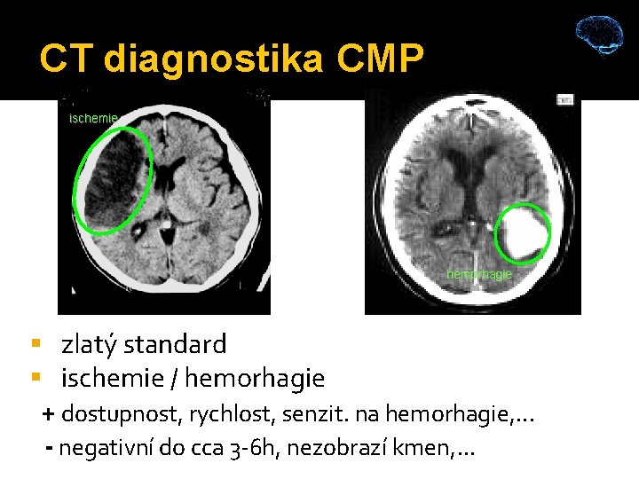 CT diagnostika CMP ischemie hemorhagie zlatý standard ischemie / hemorhagie + dostupnost, rychlost, senzit.