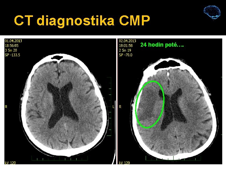 CT diagnostika CMP 24 hodin poté…. 