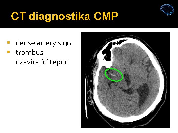 CT diagnostika CMP dense artery sign trombus uzavírající tepnu 