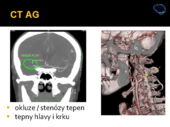 CT AG okluze ACM okluze / stenózy tepen tepny hlavy i krku 