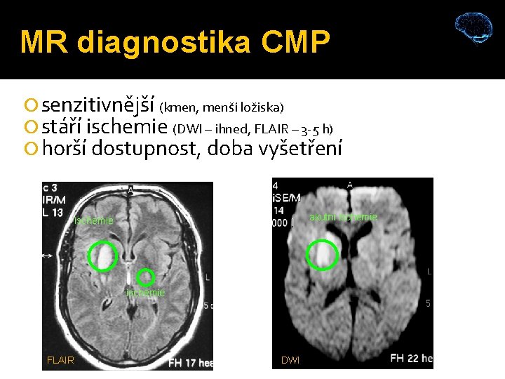 MR diagnostika CMP senzitivnější (kmen, menší ložiska) stáří ischemie (DWI – ihned, FLAIR –