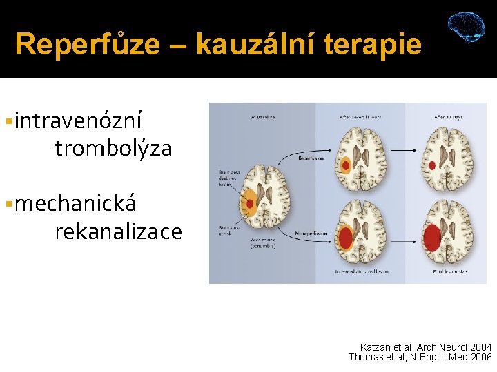 Reperfůze – kauzální terapie intravenózní trombolýza mechanická rekanalizace Katzan et al, Arch Neurol 2004