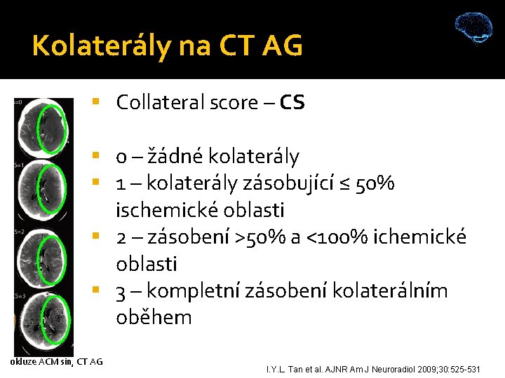 Kolaterály na CT AG Collateral score – CS 0 – žádné kolaterály 1 –