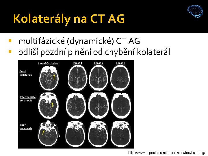 Kolaterály na CT AG multifázické (dynamické) CT AG odliší pozdní plnění od chybění kolaterál