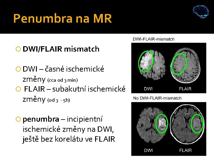 Penumbra na MR DWI/FLAIR mismatch DWI – časné ischemické změny (cca od 3 min)