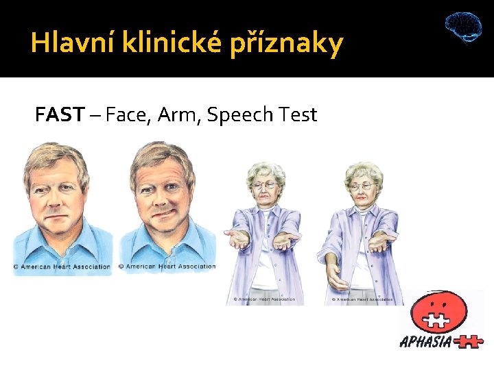 Hlavní klinické příznaky FAST – Face, Arm, Speech Test 