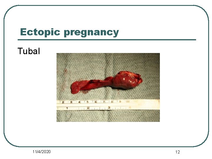 Ectopic pregnancy Tubal 11/4/2020 12 