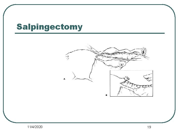 Salpingectomy 11/4/2020 19 