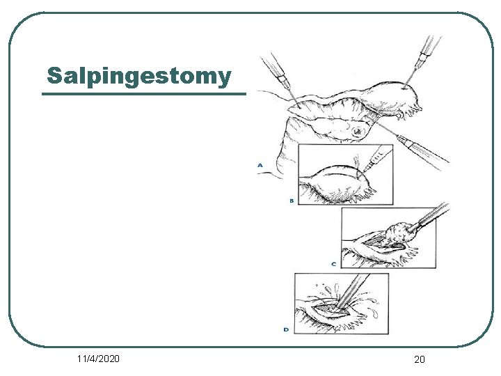 Salpingestomy 11/4/2020 20 