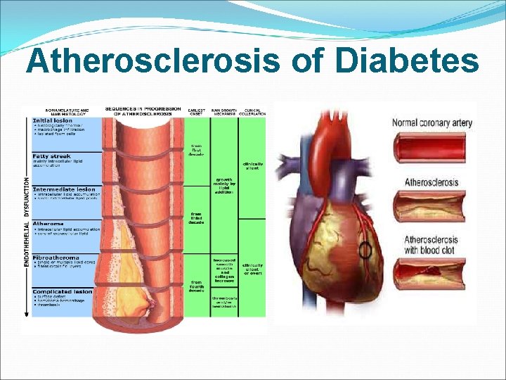 Atherosclerosis of Diabetes 